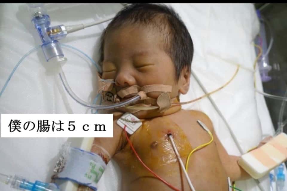 短腸症候群を知ってもらう会の画像