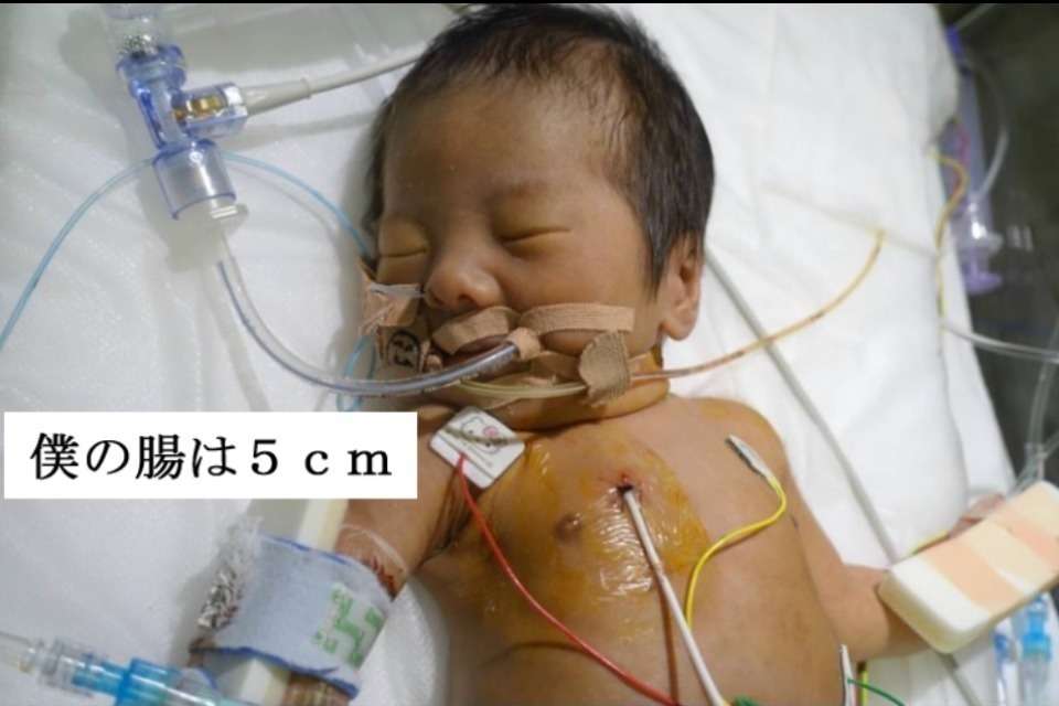 短腸症候群を知ってもらう会 Image